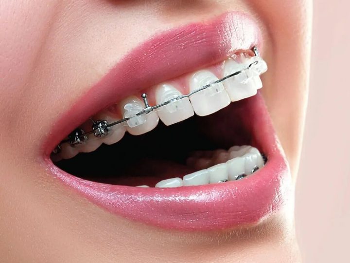 Ceramic Braces