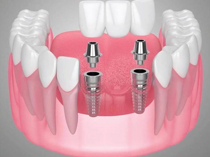 Dental Bridges